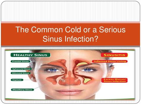 Does cold worsen sinusitis?