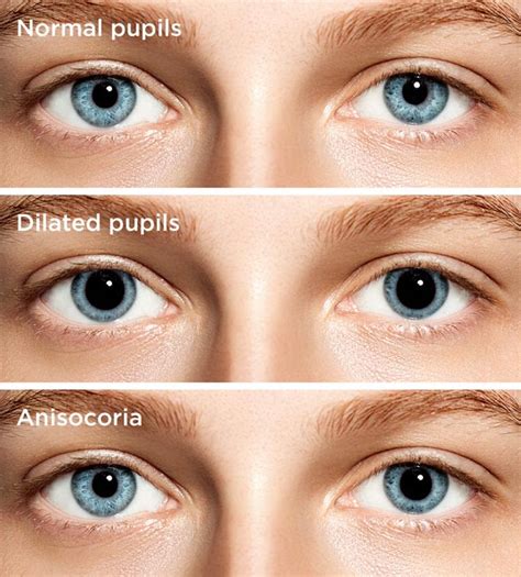 Does crying dilate your pupils?