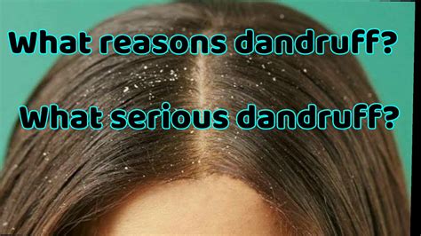 Does dandruff ever run out?