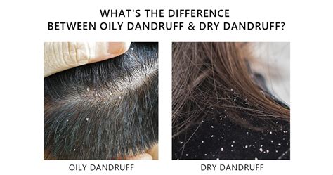 Does dandruff mean your hair is dry or oily?