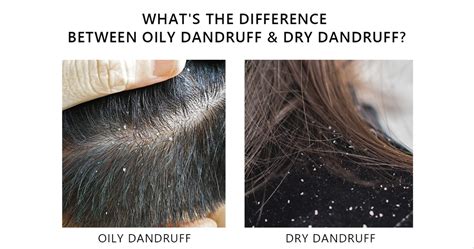 Does dandruff stick to oily hair?