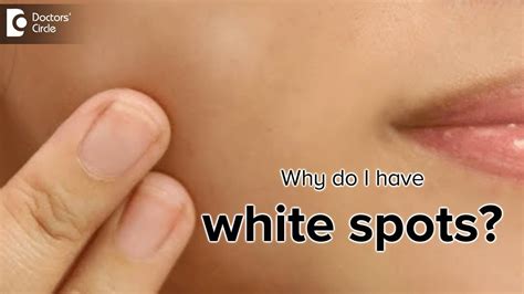 Does dead skin turn white?