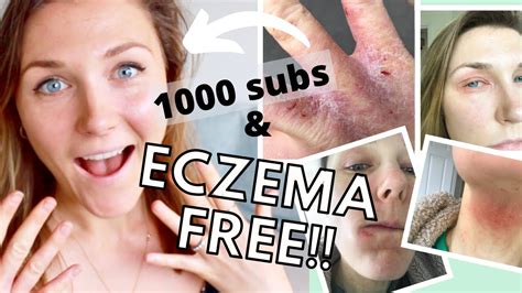 Does eczema crust when healing?