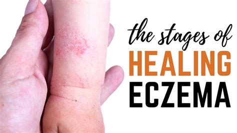 Does eczema get darker as it heals?