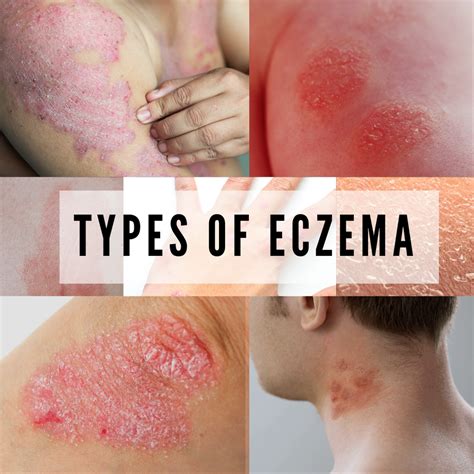 Does eczema get worse before healing?