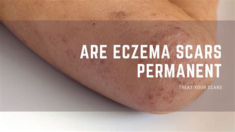 Does eczema leave scars?