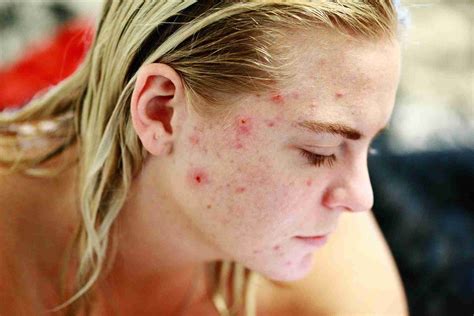 Does exfoliating help back acne?