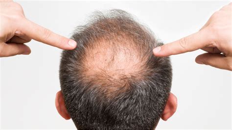 Does fasting regrow hair?