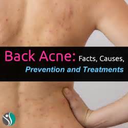 Does fat cause back acne?