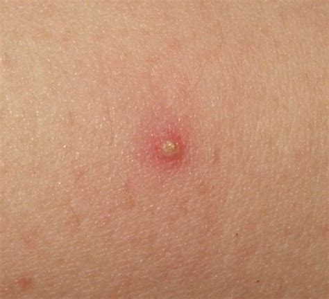 Does folliculitis always have bumps?