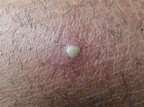 Does folliculitis bleed when popped?