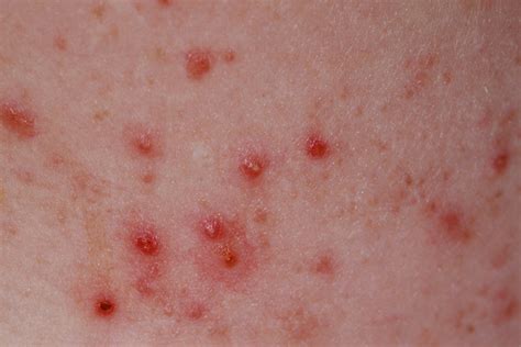 Does folliculitis leave scars?
