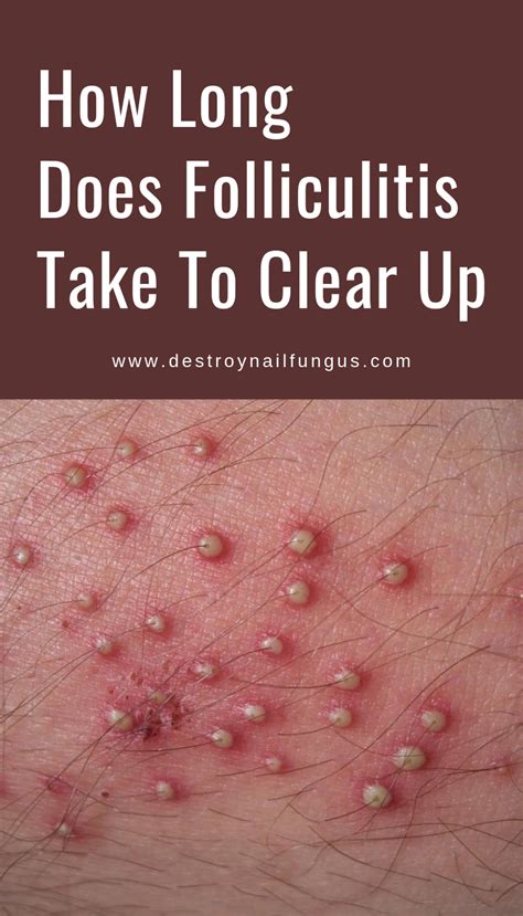 Does folliculitis pus smell?