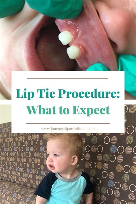 Does frenectomy change lip?