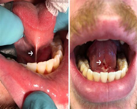 Does frenectomy leave a scar?