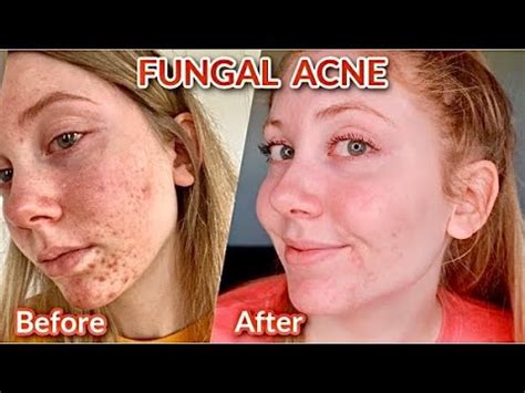 Does fungal acne go away by itself?