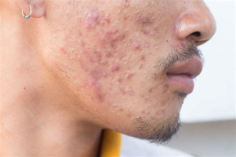 Does fungal acne leave scars?