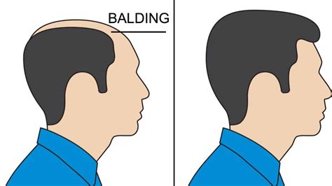 Does grey hair mean balding?