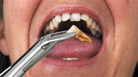 Does gum disease go away when teeth are removed?