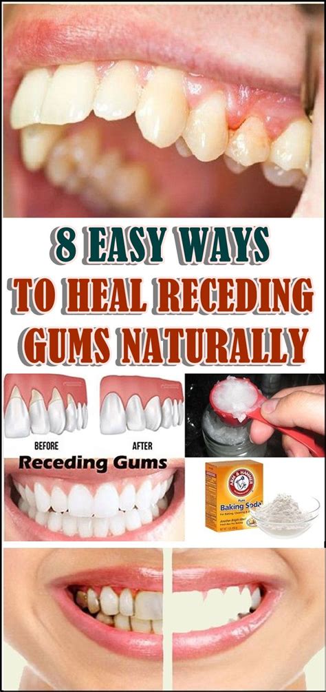 Does gum disease heal naturally?
