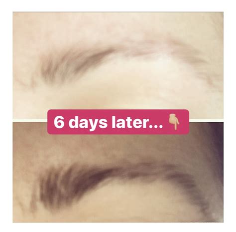Does hair grow back after trichotillomania?