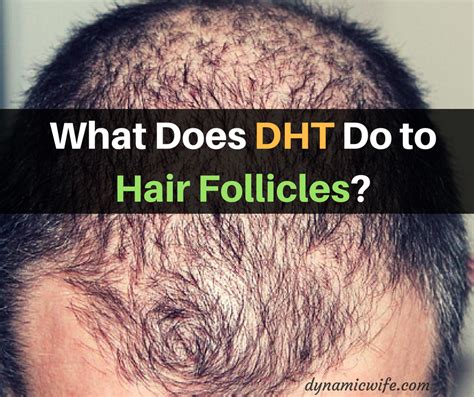 Does hair sebum contain DHT?