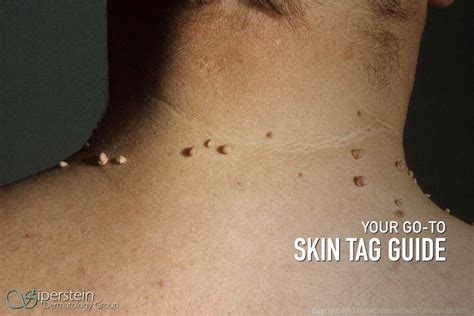 Does having a lot of skin tags mean anything?