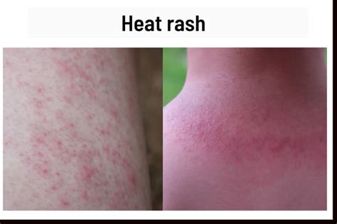 Does heat and sweat make poison ivy worse?