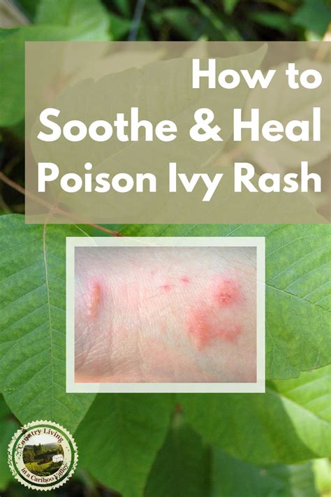 Does heat help poison ivy?