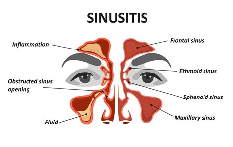 Does heat open sinuses?