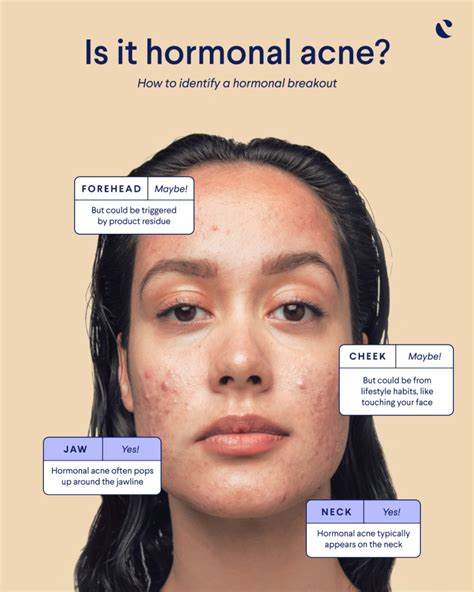 Does high progesterone cause acne?