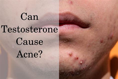 Does high testosterone cause acne?