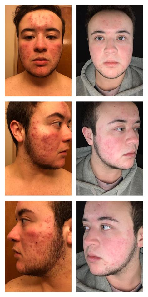 Does high testosterone cause jawline acne?