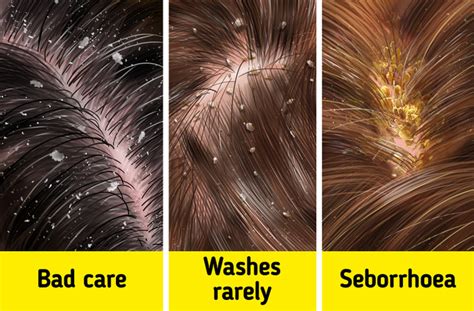 Does hot water cause dandruff?