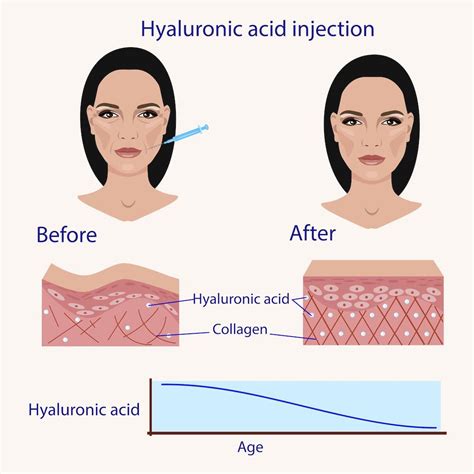 Does hyaluronic acid break down Botox?