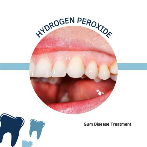 Does hydrogen peroxide help gum infection?