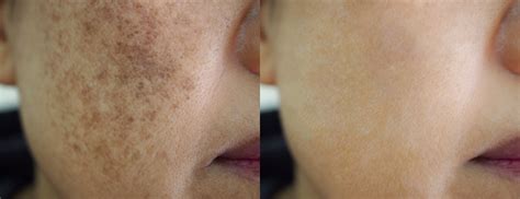 Does hyperpigmentation get darker before it fades?