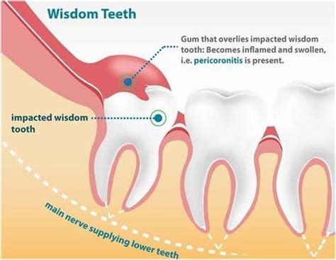 Does ibuprofen help pericoronitis?