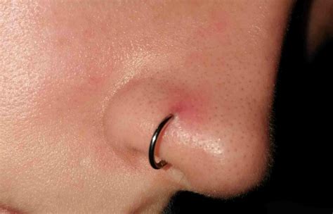 Does ice help an infected piercing?