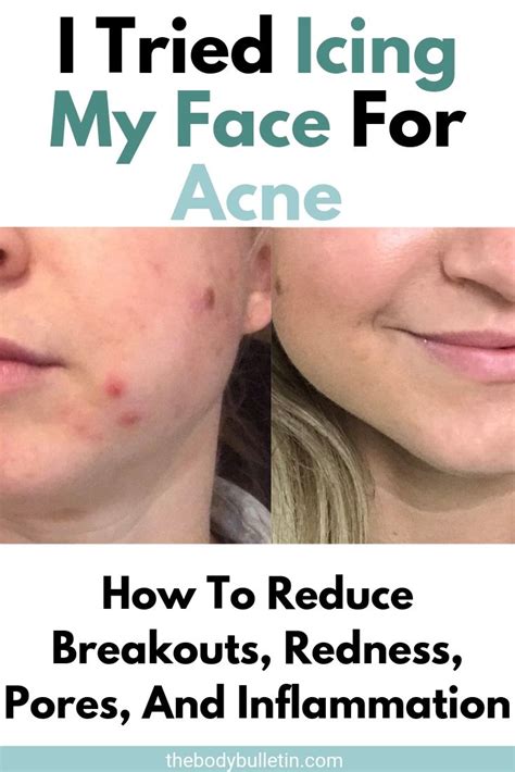 Does ice help or worsen acne?