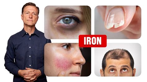 Does iron affect skin?