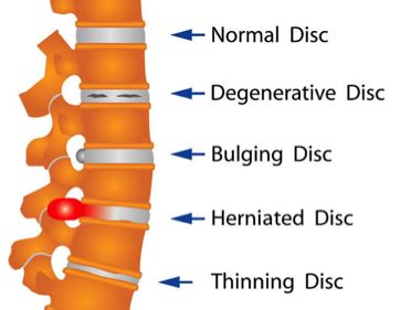 Does it hurt to walk with a bulging disc?