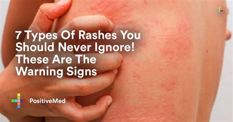 Does itching rashes make it worse?