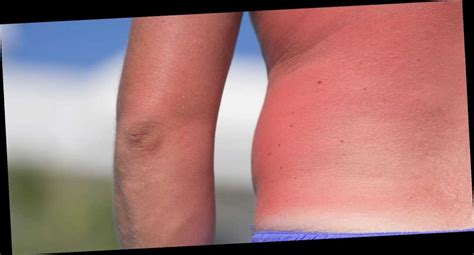 Does itchy sunburn mean it's healing?