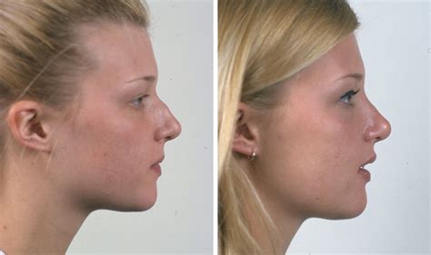 Does jawline change after tooth extraction?