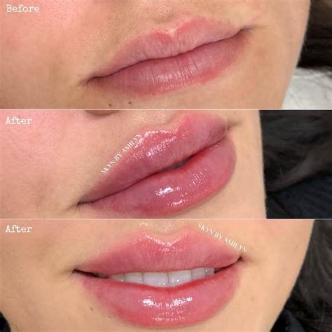 Does kissing someone with lip fillers feel different?