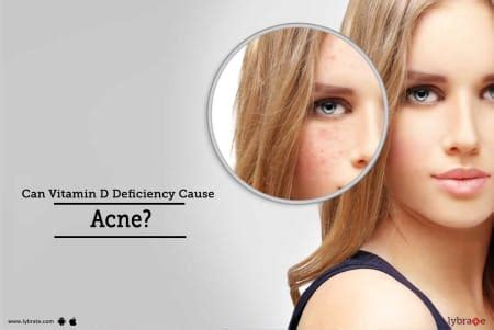 Does lack of vitamin D cause acne?