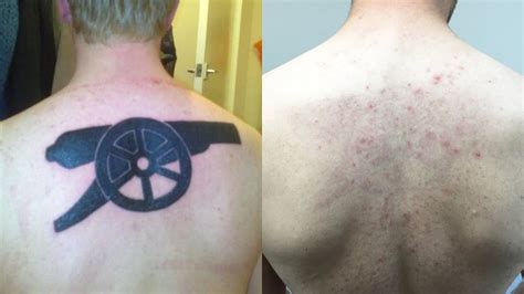 Does laser removal hurt more than tattoo?
