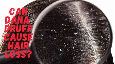Does leaving hair wet make dandruff worse?