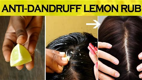 Does lemon remove dandruff?